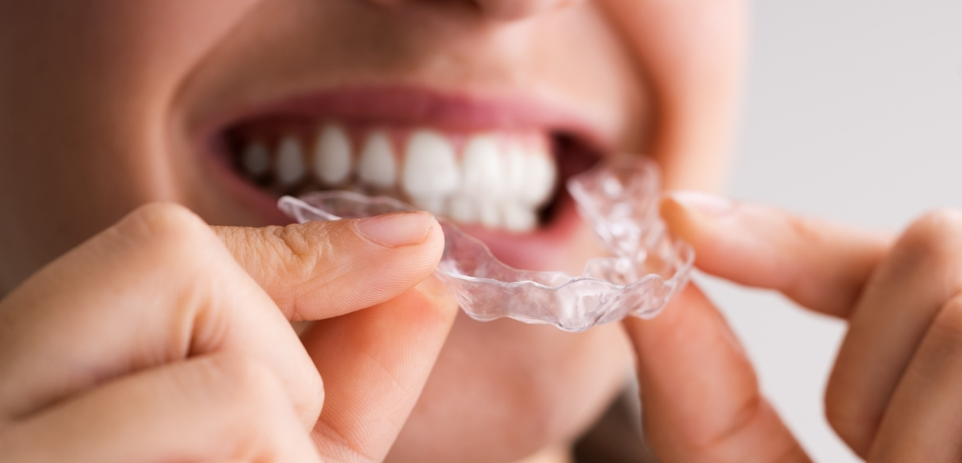 Clear Aligners | clear aligners