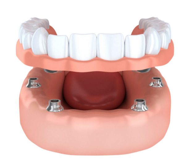 dental_implants_Seattle