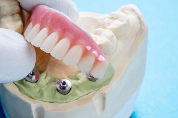 All_on_4s_dental_implants_Seattle