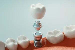 How Long Does a Dental Implant Last? |