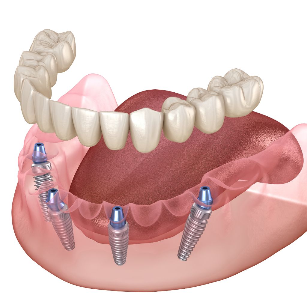 allon4dental implants