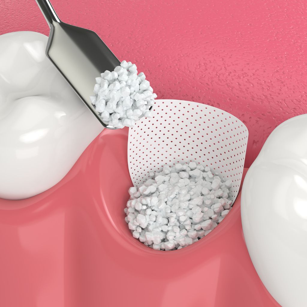 Oral Surgery in Seattle, WA dental bone grafting