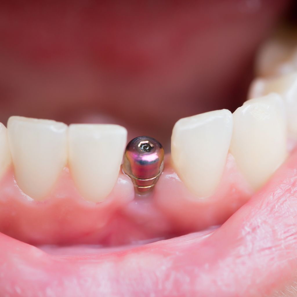 dental implant front