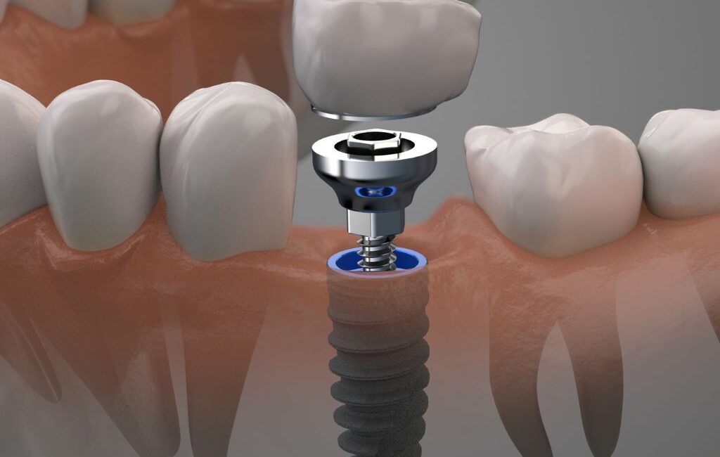 dental implants