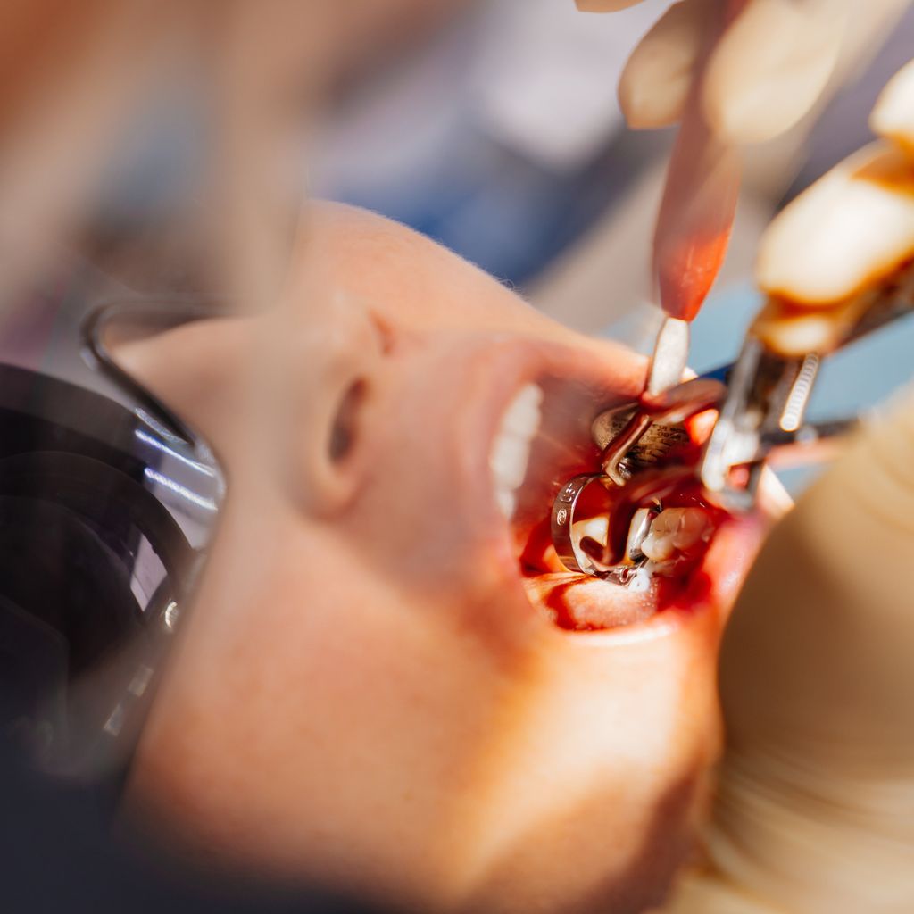 Wisdom Tooth Removal in Seattle, WA Wisdom Tooth Removal in Seattle, WA | oral surgery seattle
