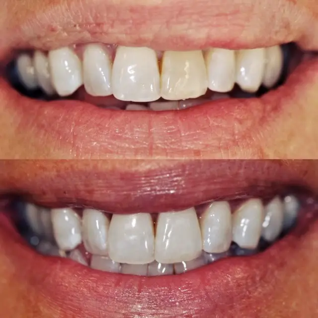 Periodontist in Seattle, WA periodontics results