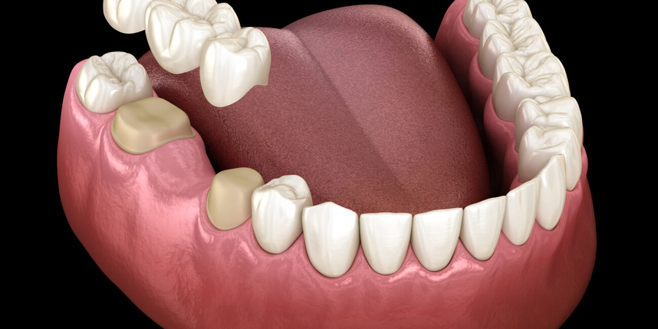 Dental bridge