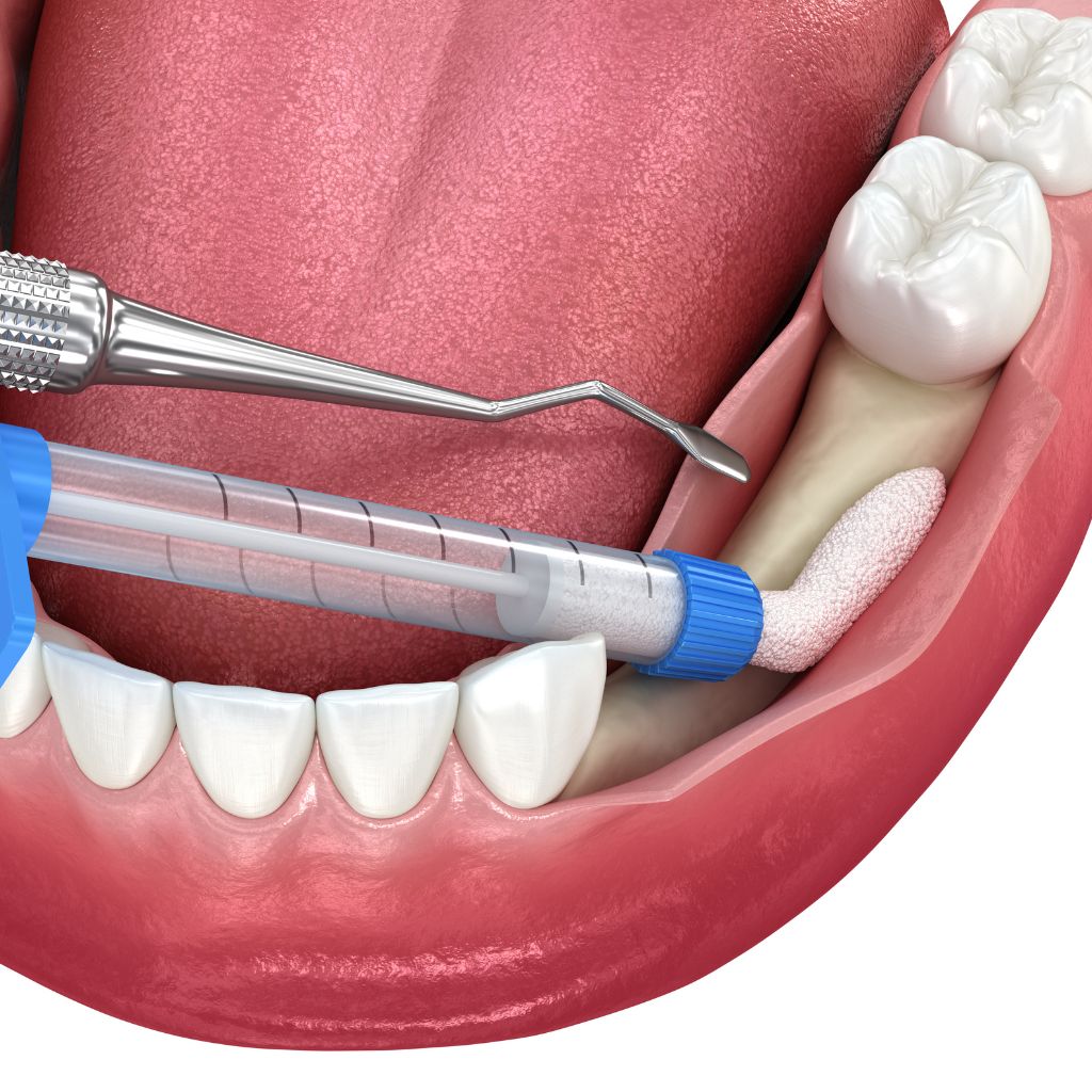 Dental Bone Grafting in Seattle, WA Dental Bone Grafting in Seattle, WA | oral surgery seattle