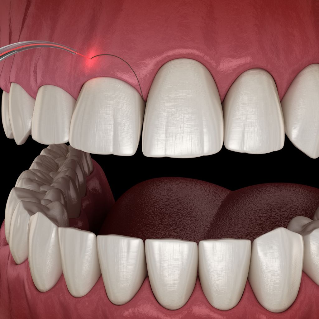 Periodontist in Seattle, WA gum contouring procedure