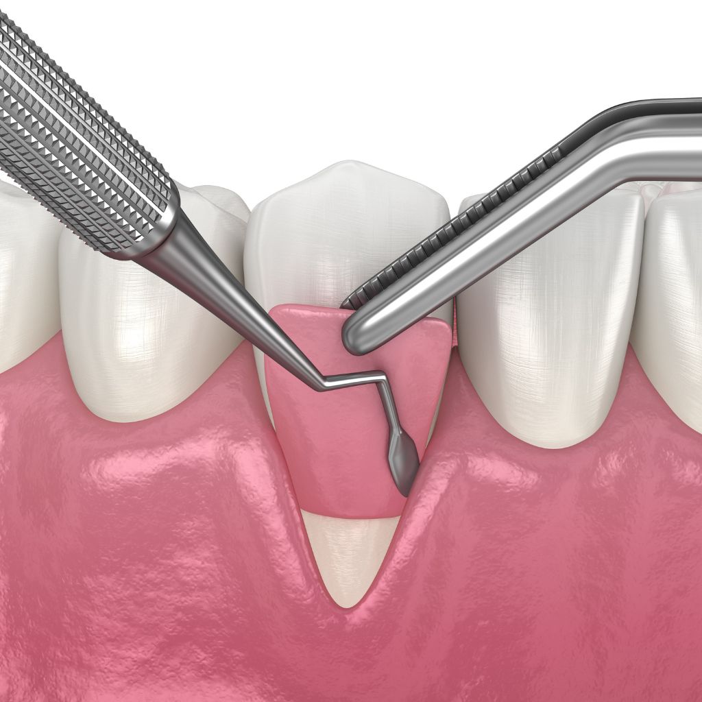 Gum Grafting in Seattle, WA gum grafting procedure