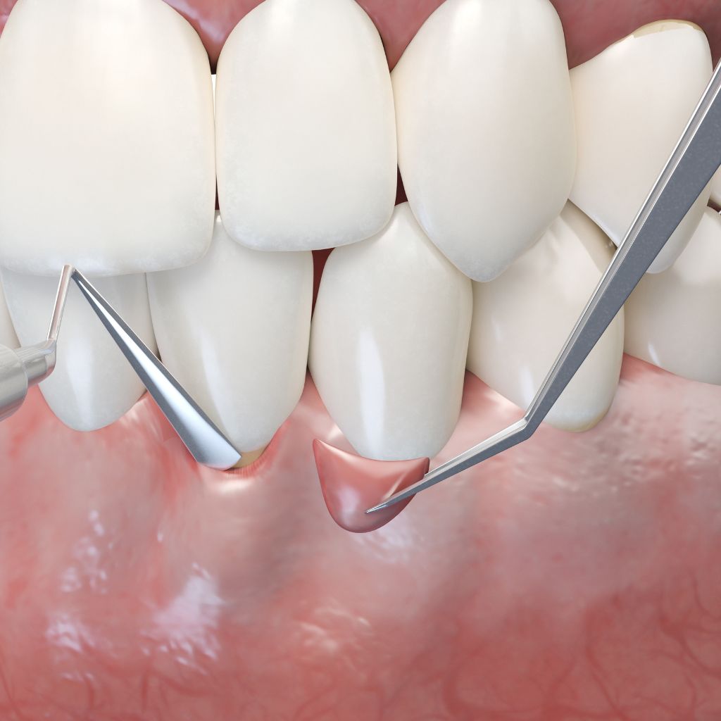 Gum Grafting in Seattle, WA Gum Grafting in Seattle, WA | oral surgery seattle