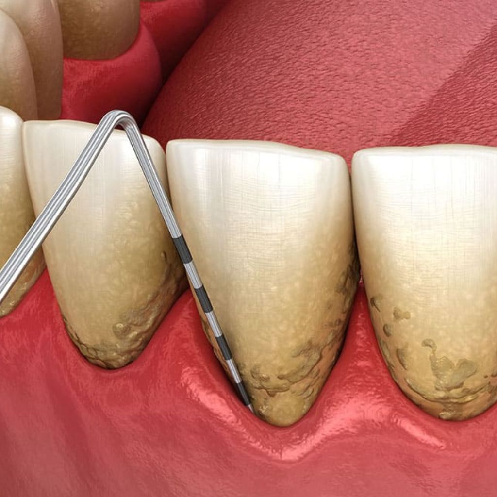 Osseuous Surgery in Seattle, WA osseuous surgery procedure