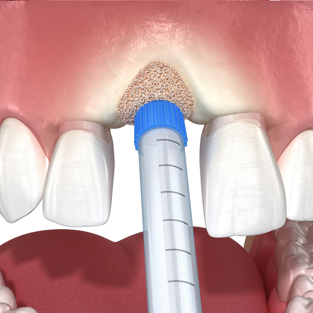 Dental Bone Grafting in Seattle, WA Dental Bone Grafting in Seattle, WA | oral surgery seattle