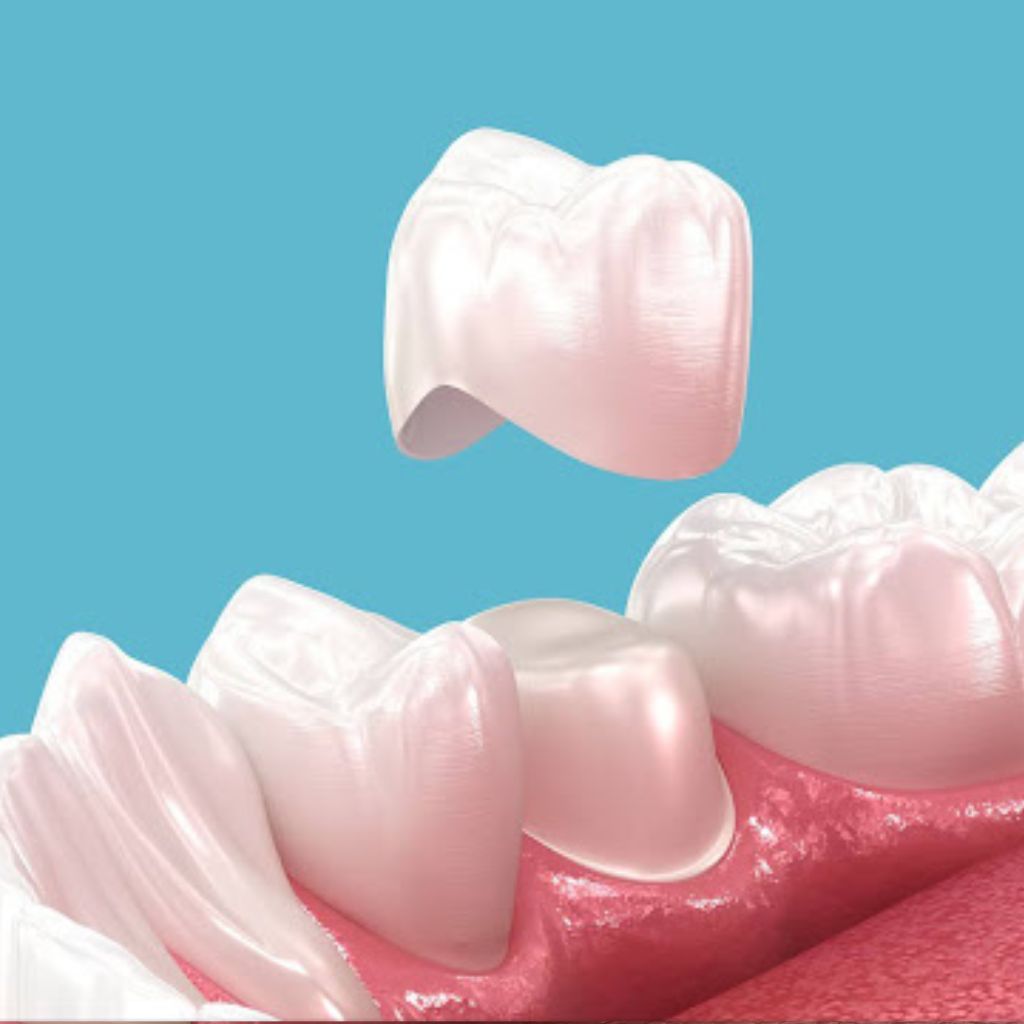 Cosmetic Dentistry in Seattle, WA porcelain crown