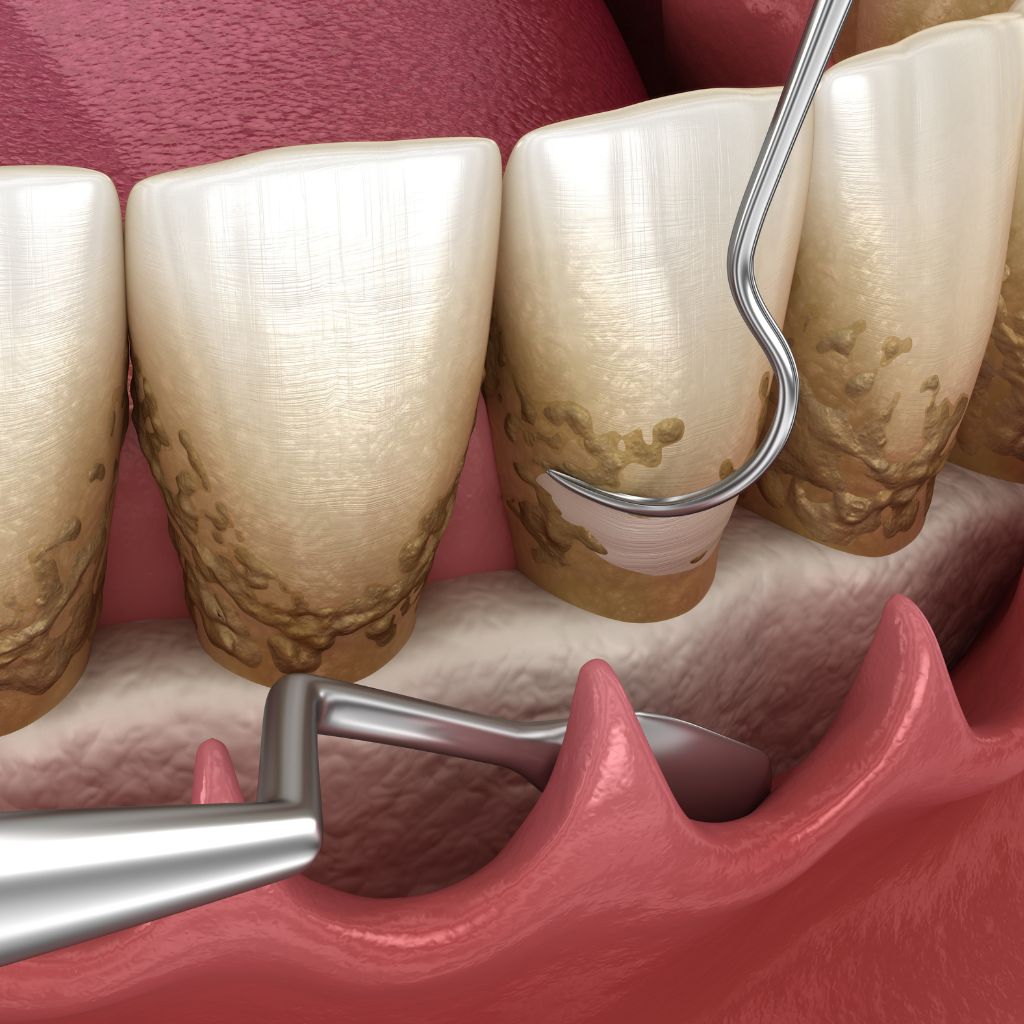 scaling and root planing deep cleaning