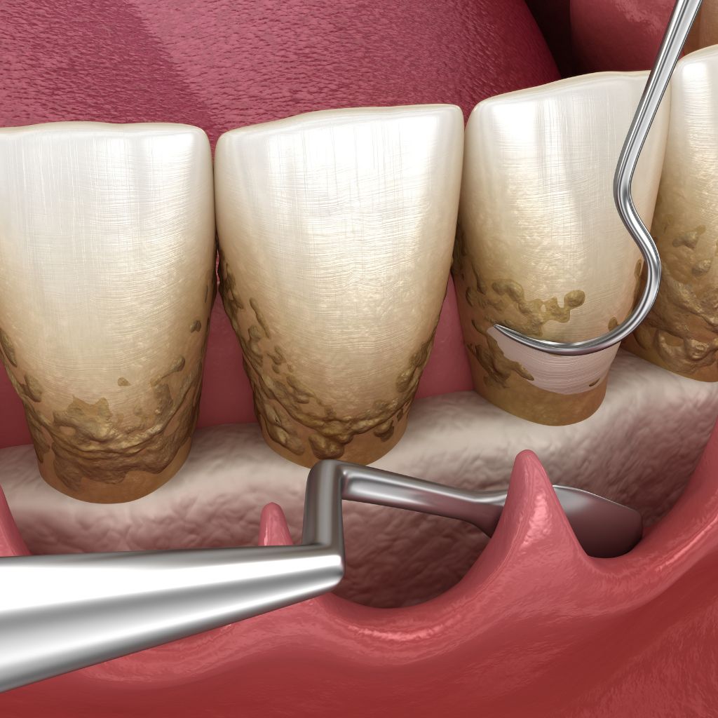 Periodontist in Seattle, WA scaling and root planing procedure