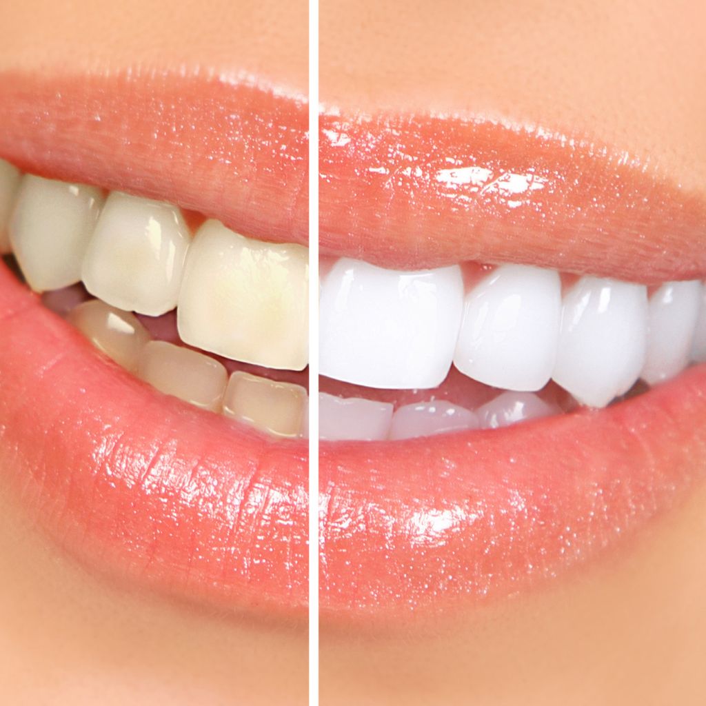 showing the teeth whitening results