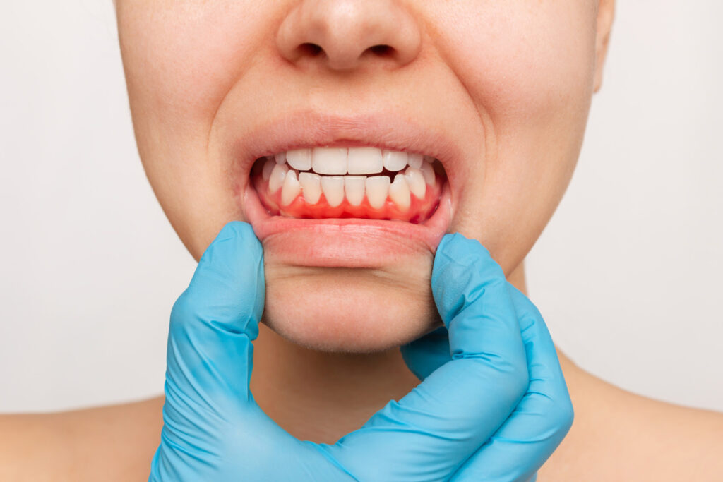 Gum inflammation
