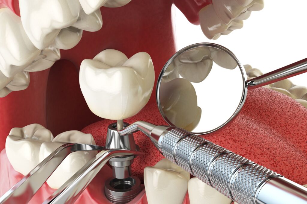 a single dental implant