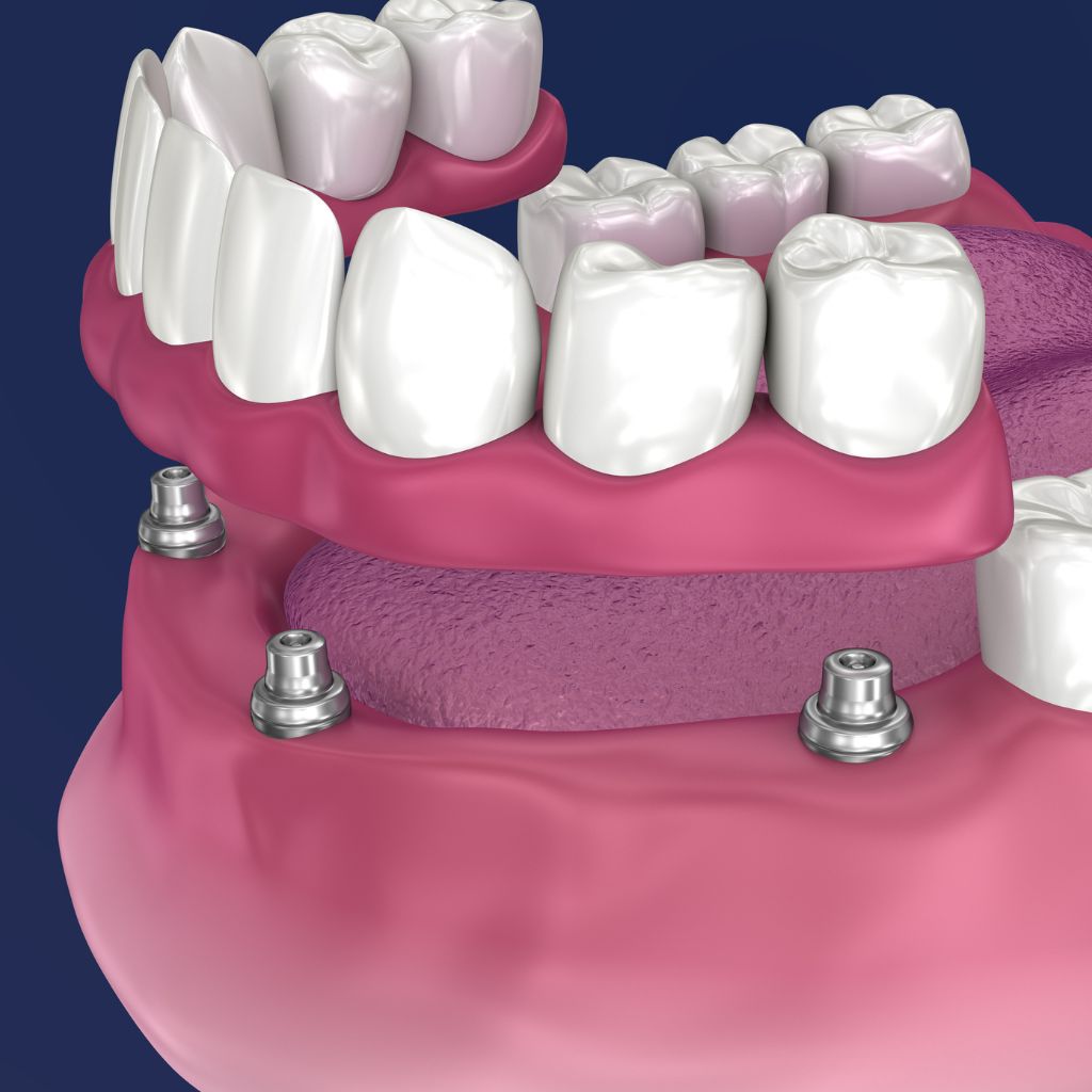 All On 4 Dental Implants in Seattle, WA All On 4 Dental Implants in Seattle, WA | oral surgery seattle