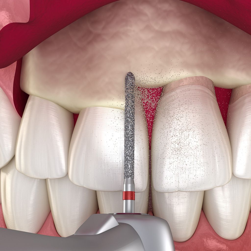 Crown Lengthening in Seattle, WA Crown Lengthening in Seattle, WA | oral surgery seattle