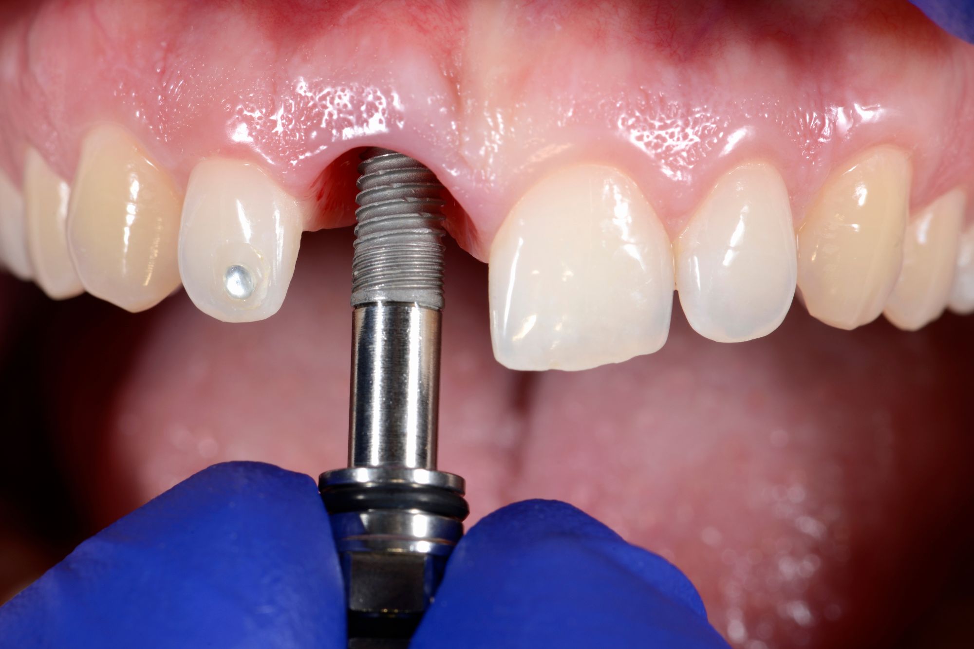 dental implant screw