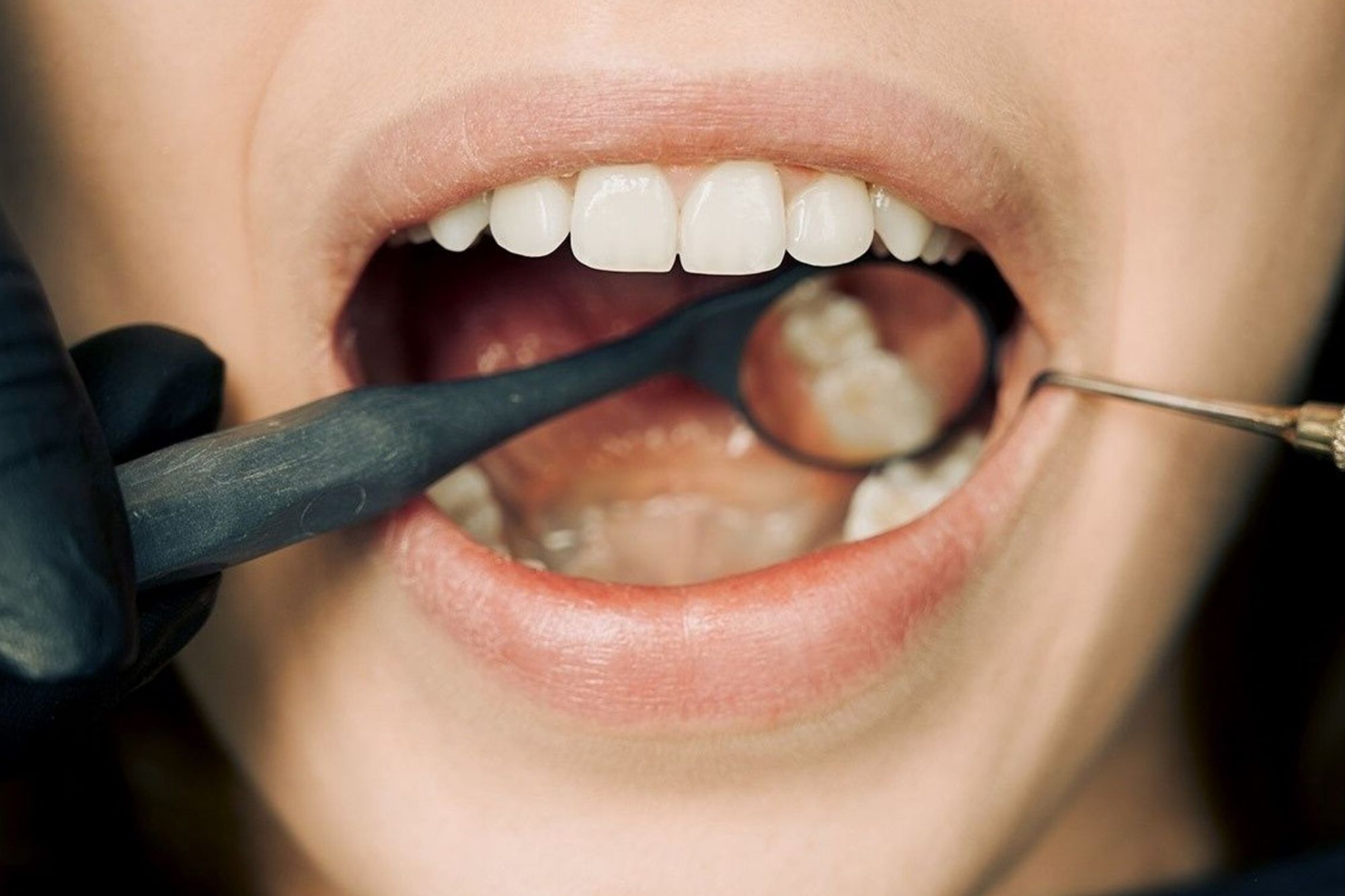 dental implants and teeth grinding