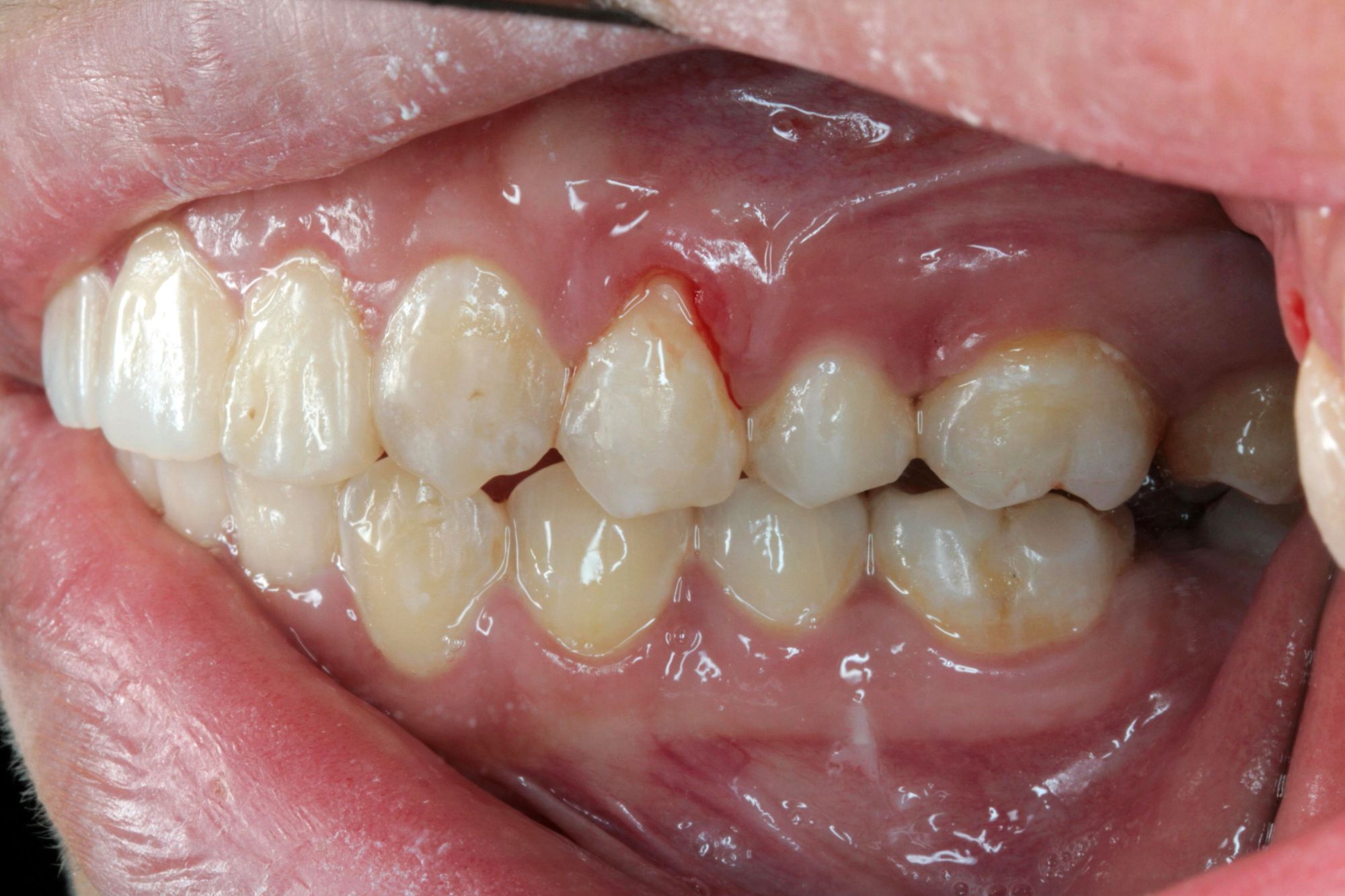 receeding gum