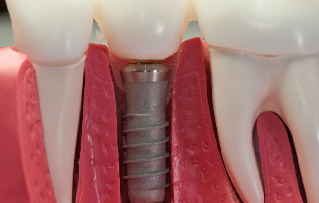 Are Dental Implants Painful? Understanding What To Expect |
