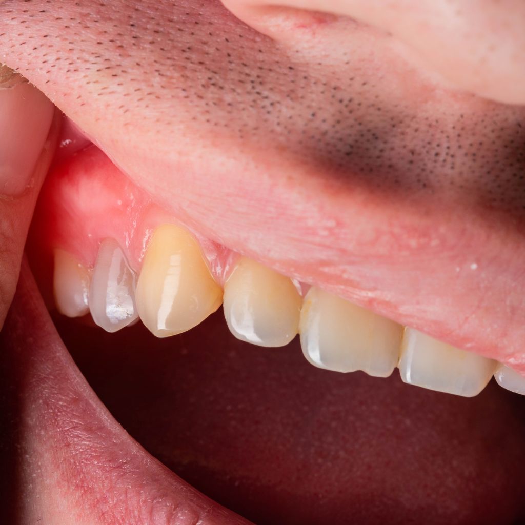 Gum Disease Treatment in Seattle, WA Gum Disease Treatment in Seattle, WA | oral surgery seattle