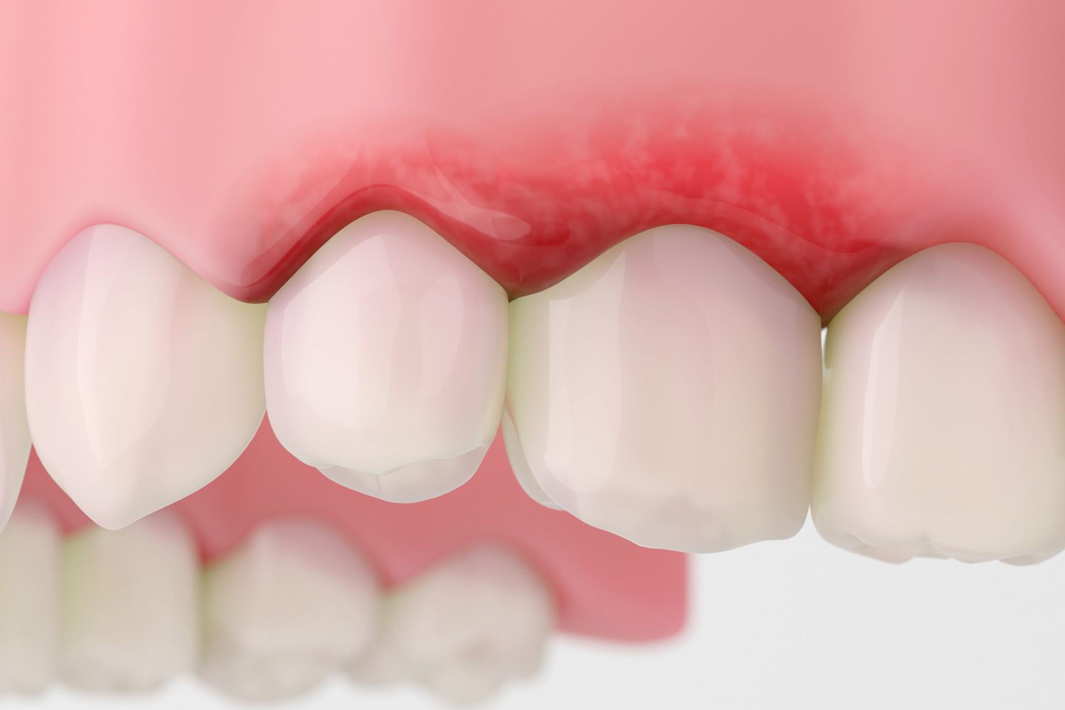 Swollen red gums with inflammation