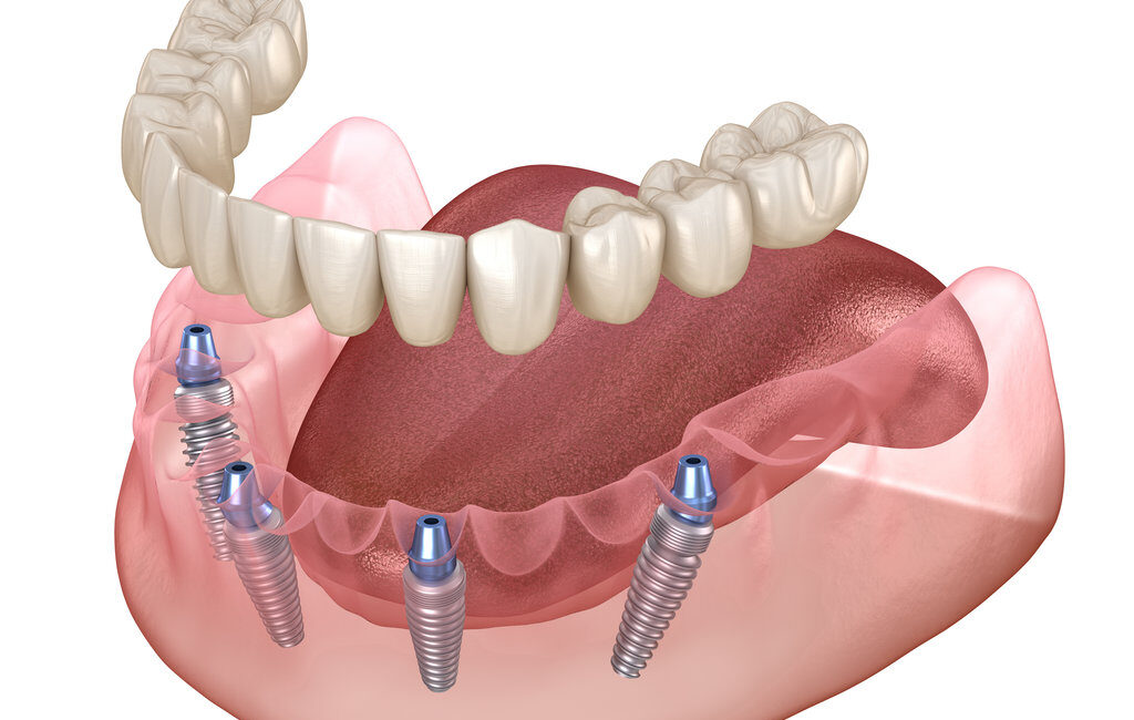 Mandibular prosthesis All on 4 system supported by implants. Medically accurate 3D illustration of human teeth and dentures concept