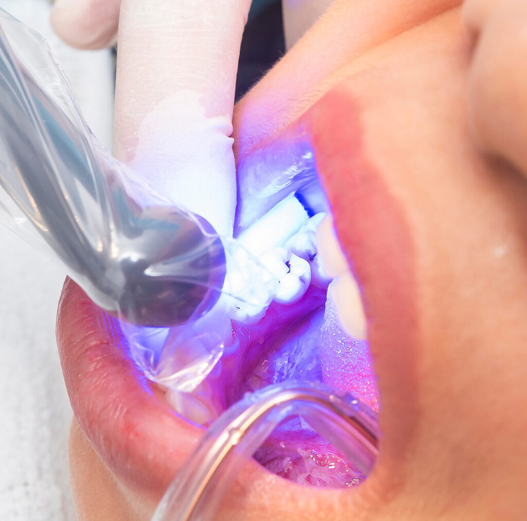 Final polymerization phase of dental composite using curing light on a lower premolar to harden the restoration material securely.